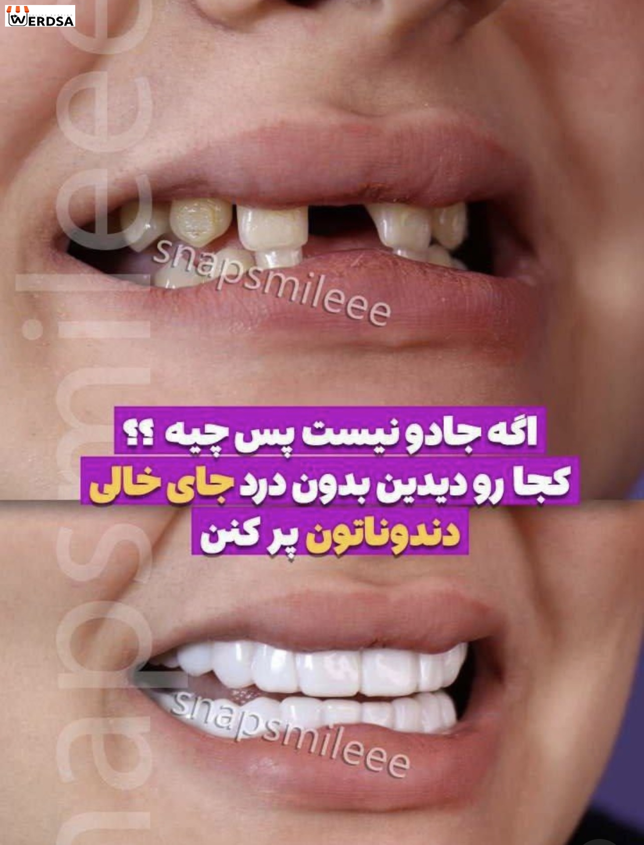 لمینت snap on smile برای دو فک با مشاوره قبل سفارش